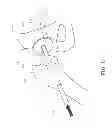 Fig. 06 - Method and apparatus for hip replacements