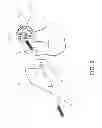 Fig. 07 - Method and apparatus for hip replacements
