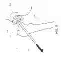 Fig. 09 - Method and apparatus for hip replacements