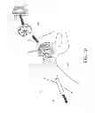 Fig. 11 - Method and apparatus for hip replacements