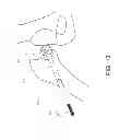 Fig. 14 - Method and apparatus for hip replacements
