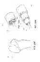 Fig. 16 - Method and apparatus for hip replacements