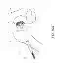 Fig. 17 - Method and apparatus for hip replacements