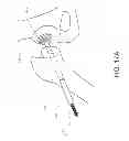 Fig. 19 - Method and apparatus for hip replacements