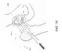 Fig. 22 - Method and apparatus for hip replacements