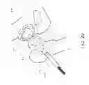 Fig. 23 - Method and apparatus for hip replacements