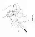 Fig. 25 - Method and apparatus for hip replacements