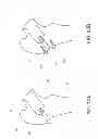 Fig. 26 - Method and apparatus for hip replacements