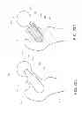 Fig. 28 - Method and apparatus for hip replacements