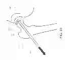 Fig. 29 - Method and apparatus for hip replacements