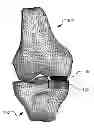 Fig. 01 - Customized arthroplasty cutting guides and surgical methods using the same