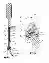 Fig. 03 - Pop on spreader system