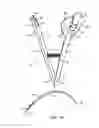 Fig. 02 - HANDHELD SAFETY SUTURING DEVICE