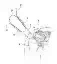 Fig. 01 - Suture Passer and Subcortical Knot Placement