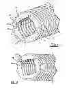 Fig. 03 - Helical fibrin removal tool