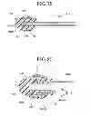 Fig. 10 - METHOD OF TREATING A LUMEN REGION OF A SUBJECT