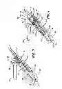 Fig. 02 - Knotless suture anchor