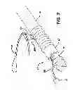 Fig. 03 - Knotless suture anchor