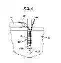 Fig. 04 - Knotless suture anchor