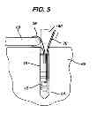 Fig. 05 - Knotless suture anchor