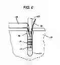 Fig. 06 - Knotless suture anchor