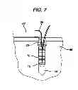 Fig. 07 - Knotless suture anchor