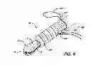 Fig. 09 - Knotless suture anchor