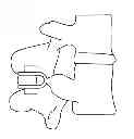Fig. 01 - Dynamized Interspinal Implant