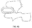 Fig. 07 - Dynamized Interspinal Implant
