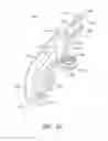 Fig. 32 - Spinous process device and method of use