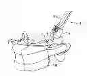 Fig. 01 - Instrument for assembling a polyaxial bone anchor