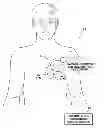 Fig. 01 - Systems and methods for packed pacing using bifurcated pacing pulses of opposing polarity generated by an implantable medical device