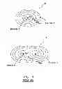 Fig. 05 - Systems and methods for packed pacing using bifurcated pacing pulses of opposing polarity generated by an implantable medical device