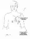 Fig. 07 - Systems and methods for packed pacing using bifurcated pacing pulses of opposing polarity generated by an implantable medical device
