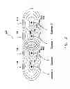 Fig. 10 - Systems and methods for packed pacing using bifurcated pacing pulses of opposing polarity generated by an implantable medical device