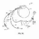Fig. 03 - Mechanism for detecting coronary ischemia