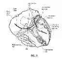 Fig. 05 - Mechanism for detecting coronary ischemia