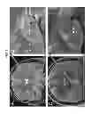 Fig. 07 - Specific deep brain stimulation for enhancement of memory
