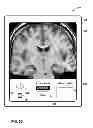 Fig. 34 - User interface with 3D environment for configuring stimulation therapy
