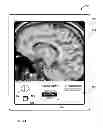 Fig. 35 - User interface with 3D environment for configuring stimulation therapy