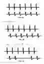 Fig. 08 - Combination therapy including peripheral nerve field stimulation