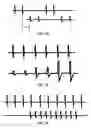Fig. 09 - Combination therapy including peripheral nerve field stimulation