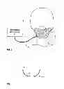 Fig. 02 - Neurostimulator for treating occipital neuralgia with housing sized and curved to conform to a subcutaneous neck region