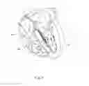 Fig. 02 - Left ventricular intraseptal stimulation lead