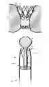 Fig. 01 - Retaining cage to permit resheathing of a tavi aortic-first transapical system