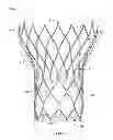 Fig. 02 - Retaining cage to permit resheathing of a tavi aortic-first transapical system