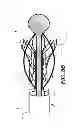 Fig. 06 - Retaining cage to permit resheathing of a tavi aortic-first transapical system