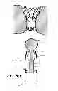 Fig. 08 - Retaining cage to permit resheathing of a tavi aortic-first transapical system