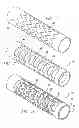 Fig. 02 - Partial encapsulation of stents