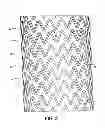 Fig. 03 - SELF-EXPANDING STENT